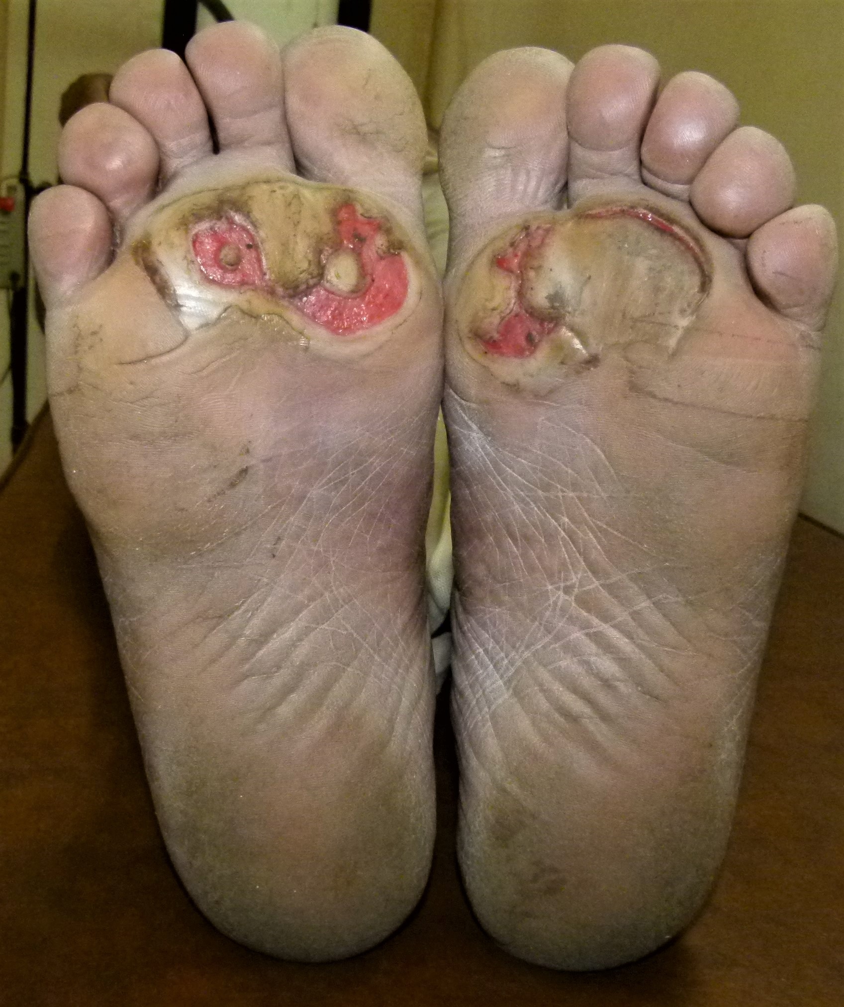 <p>Diabetic Neuropathic Ulcer
