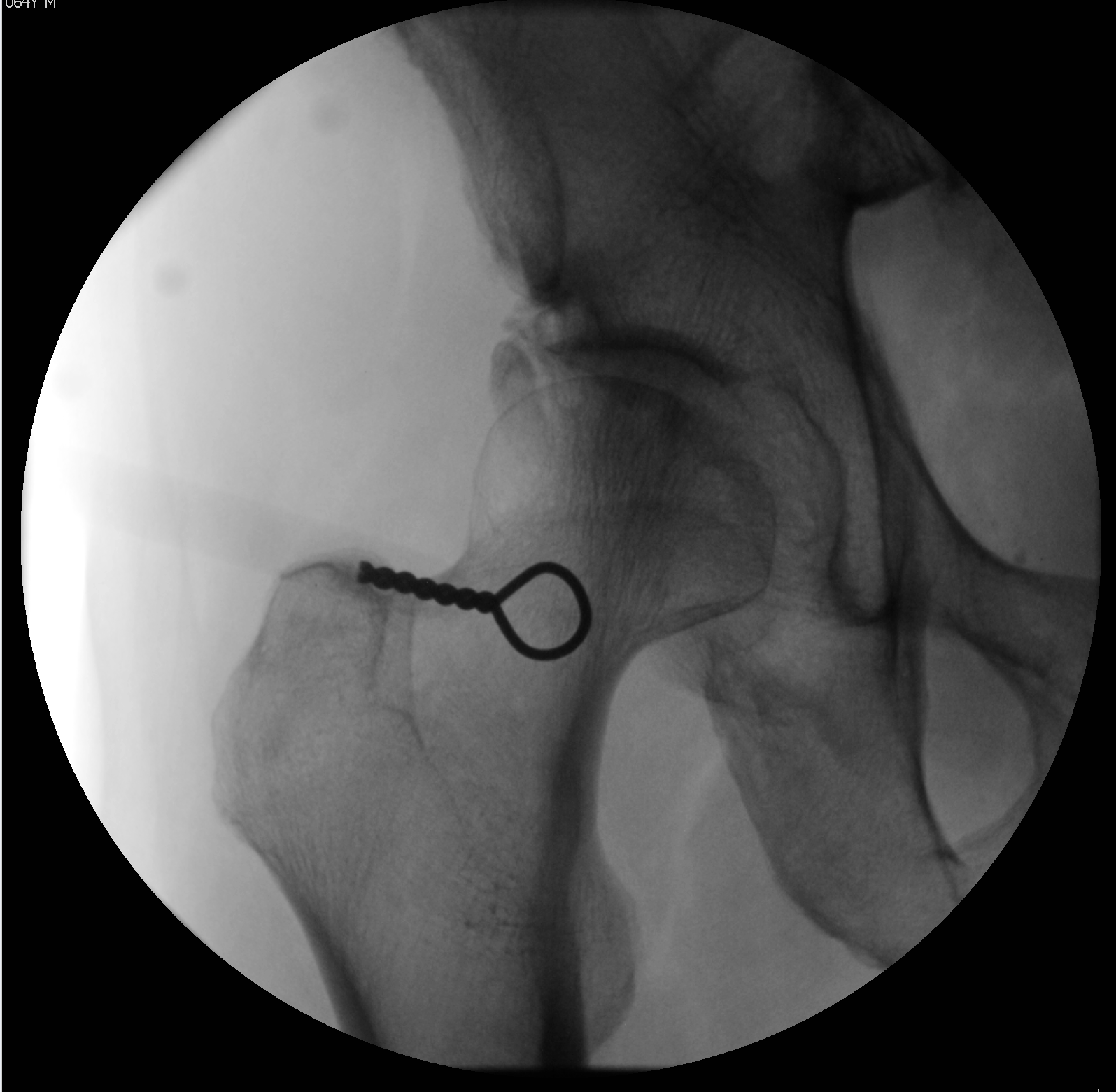 <p>Initial Fluoroscopic Visualization of the Hip Joint