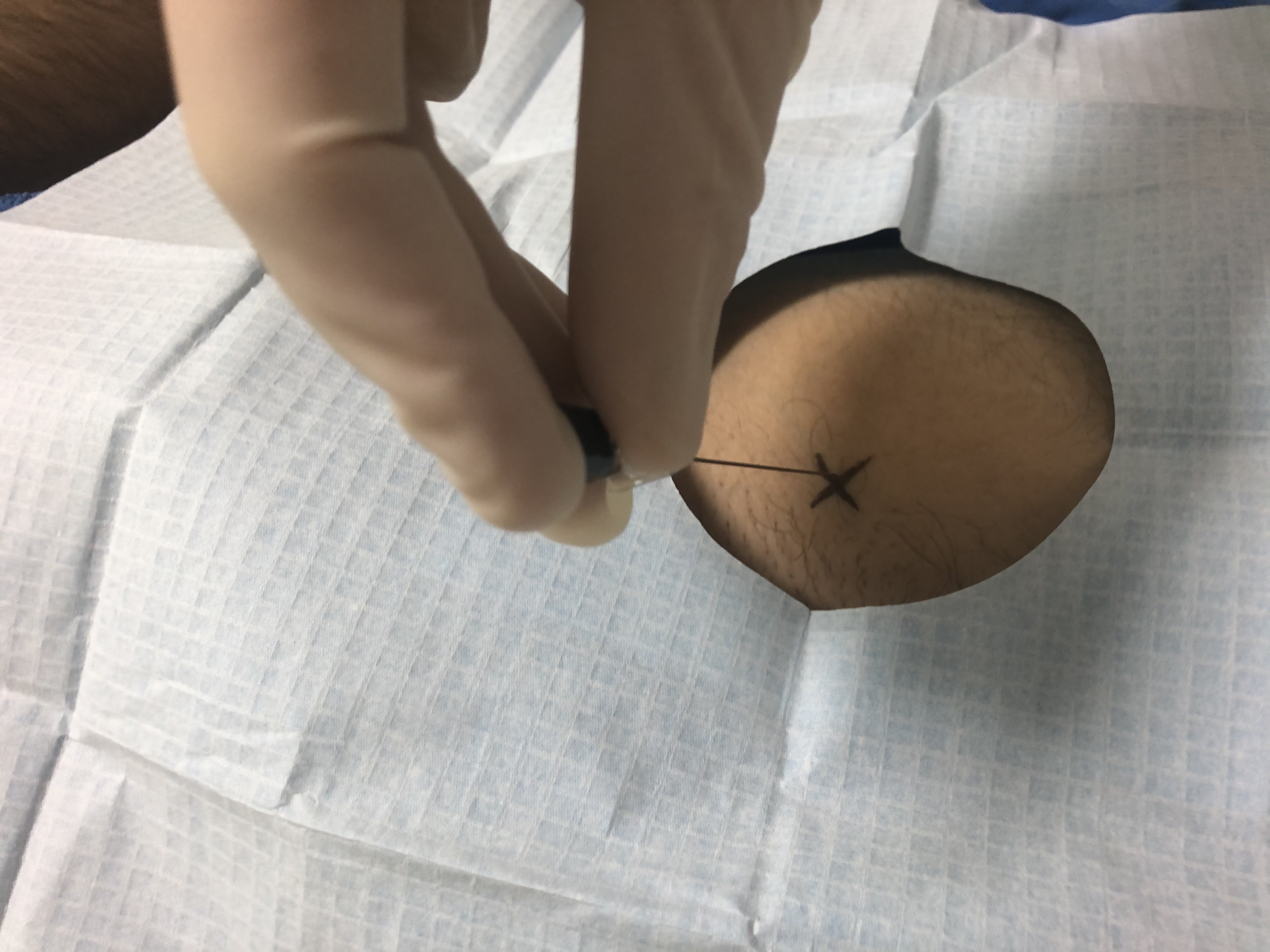 <p>Vertical Approach for Hip Joint Injection.&nbsp;Image demonstrating a vertical approach to hip joint injection.</p>