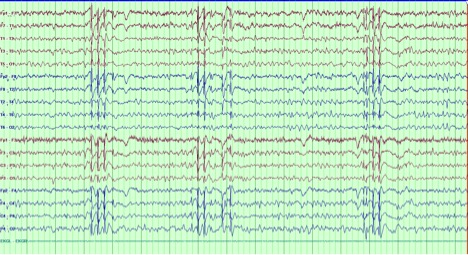 Fig 1
EEG showing 3-3.5 Hz Generalized Spike and wave and polyspike and wave discharges