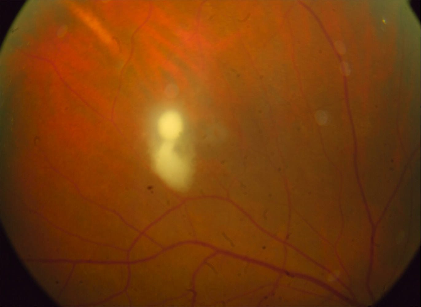 <p>Chorioretinal <em>Candida</em> Lesion