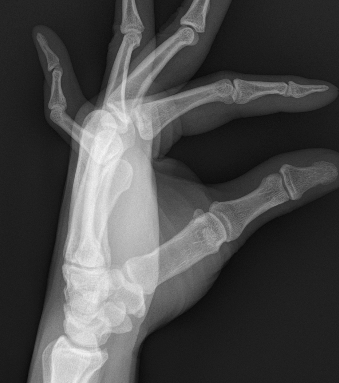 <p>Lateral Radiograph of a Fifth-Digit Boutonniere Deformity