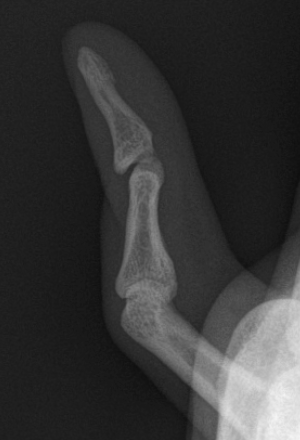 <p>Isolated Lateral View of a Fifth-Digit Boutonniere Deformity