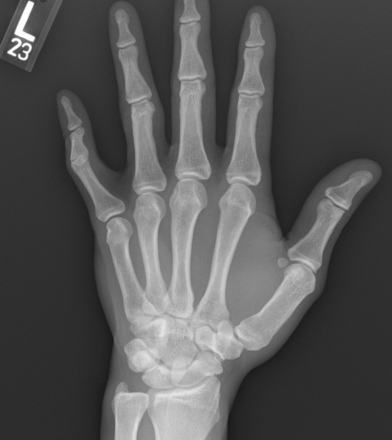 <p>Fifth-Digit Boutonniere Deformity, Posteroanterior Radiographic View