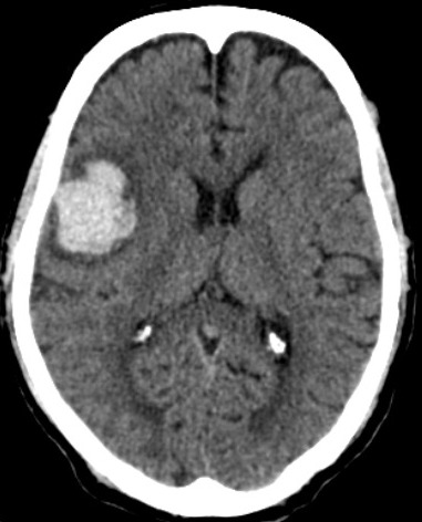 <p>Lobar Hemorrhage, Computed Tomography (CT)