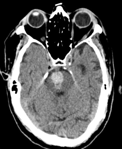<p>Pontine Hemorrhage, Computed Tomography (CT)