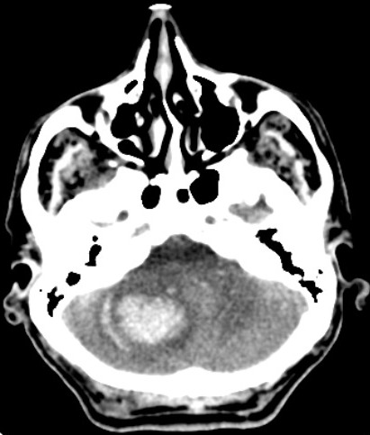 <p>Cerebellar Hemorrhage, Computed Tomography (CT)