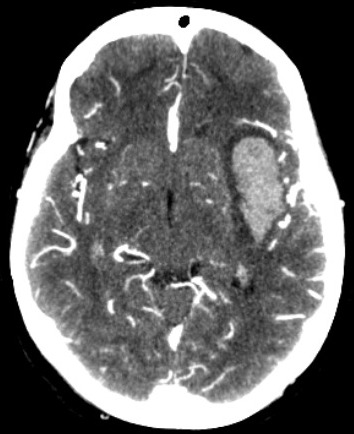 <p>Intracerebral Hemorrhage, Computed Tomography Angiogram (CTA)