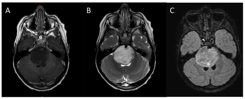<p>Diffuse Intrinsic Pontine Glioma, Magnetic Resonance Image (MRI)
