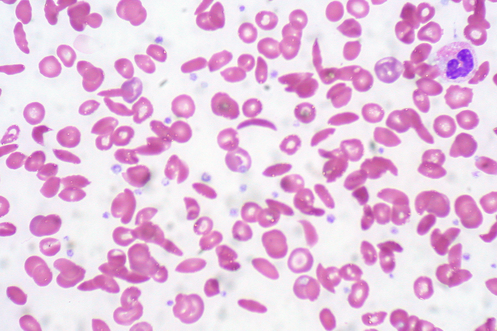 <p>Hemoglobin C in Sickle Cell Anemia