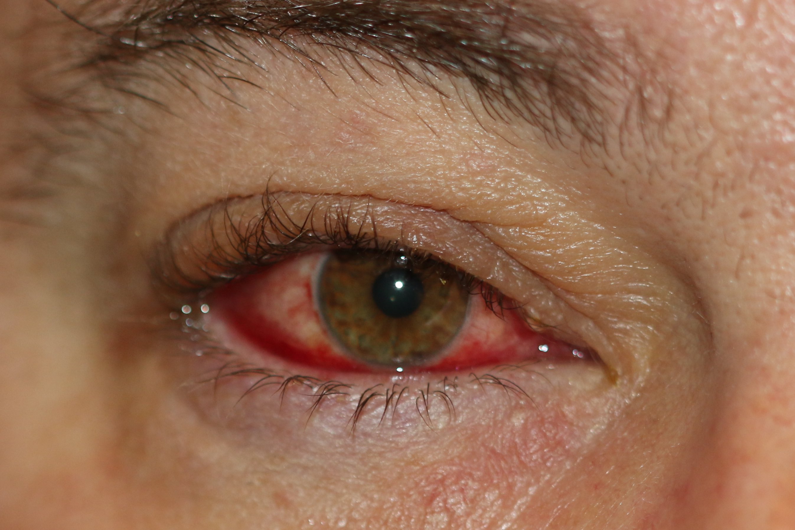 <p>Blepharoconjunctivitis
