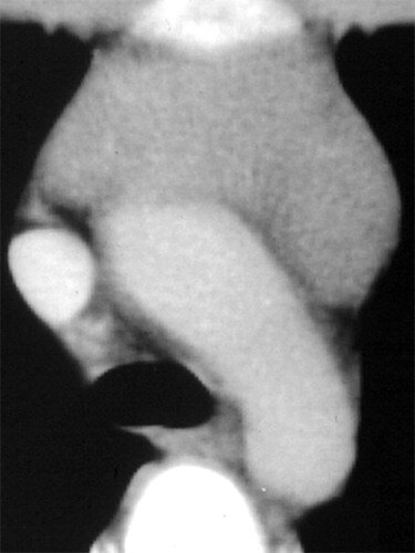 <p>Thymus on Contrast-Enhanced Computed Tomography