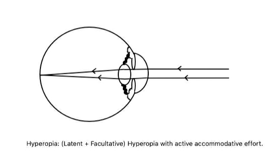 <p>Hyperopia. Compensation of the latent and facultative components of hypermetropia by accommodation.</p>