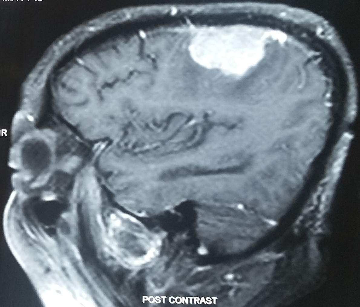 <p>Parietal Meningioma Causing Contralateral Sensory Syndrome