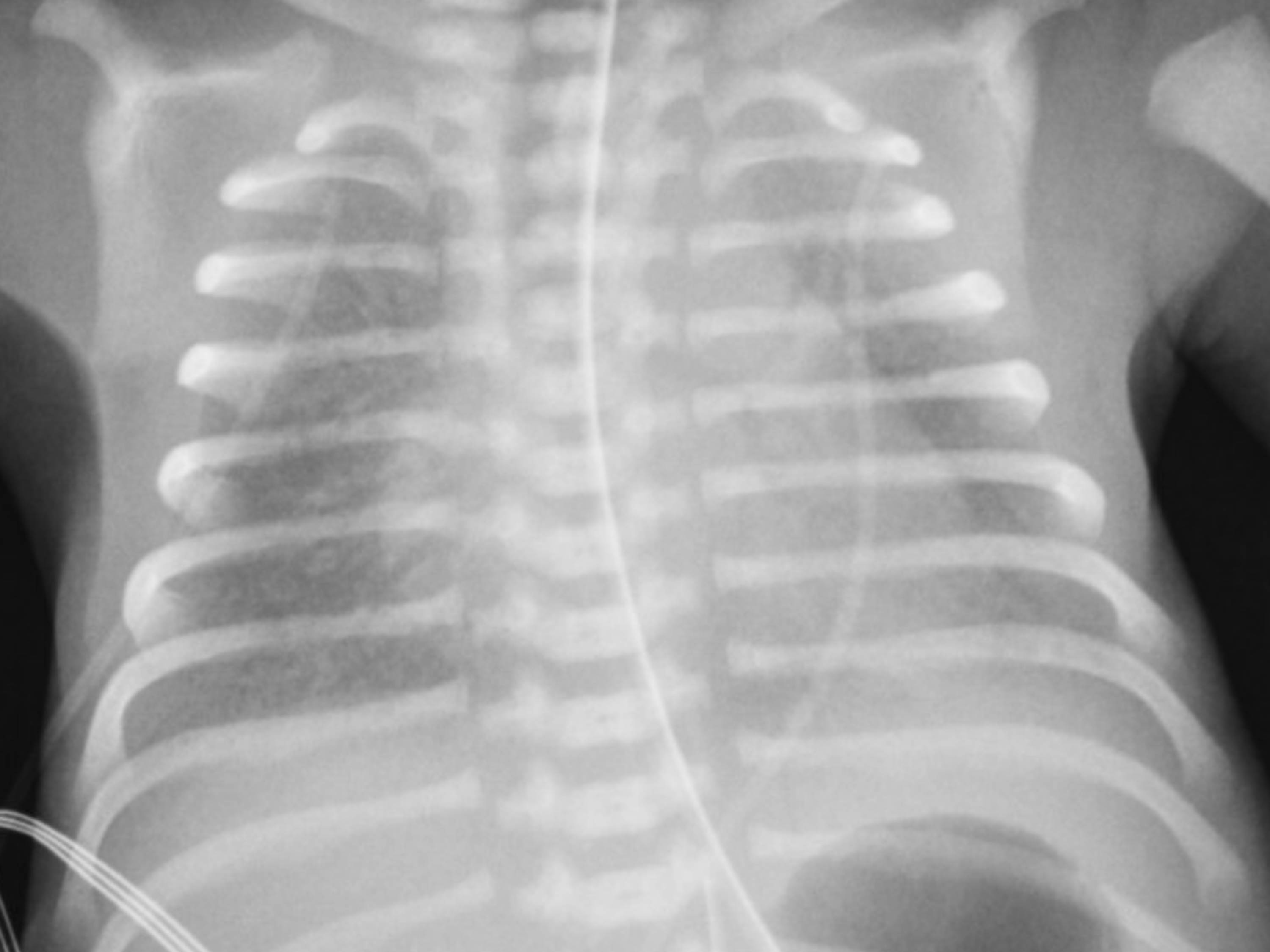 <p>Respiratory Distress Syndrome