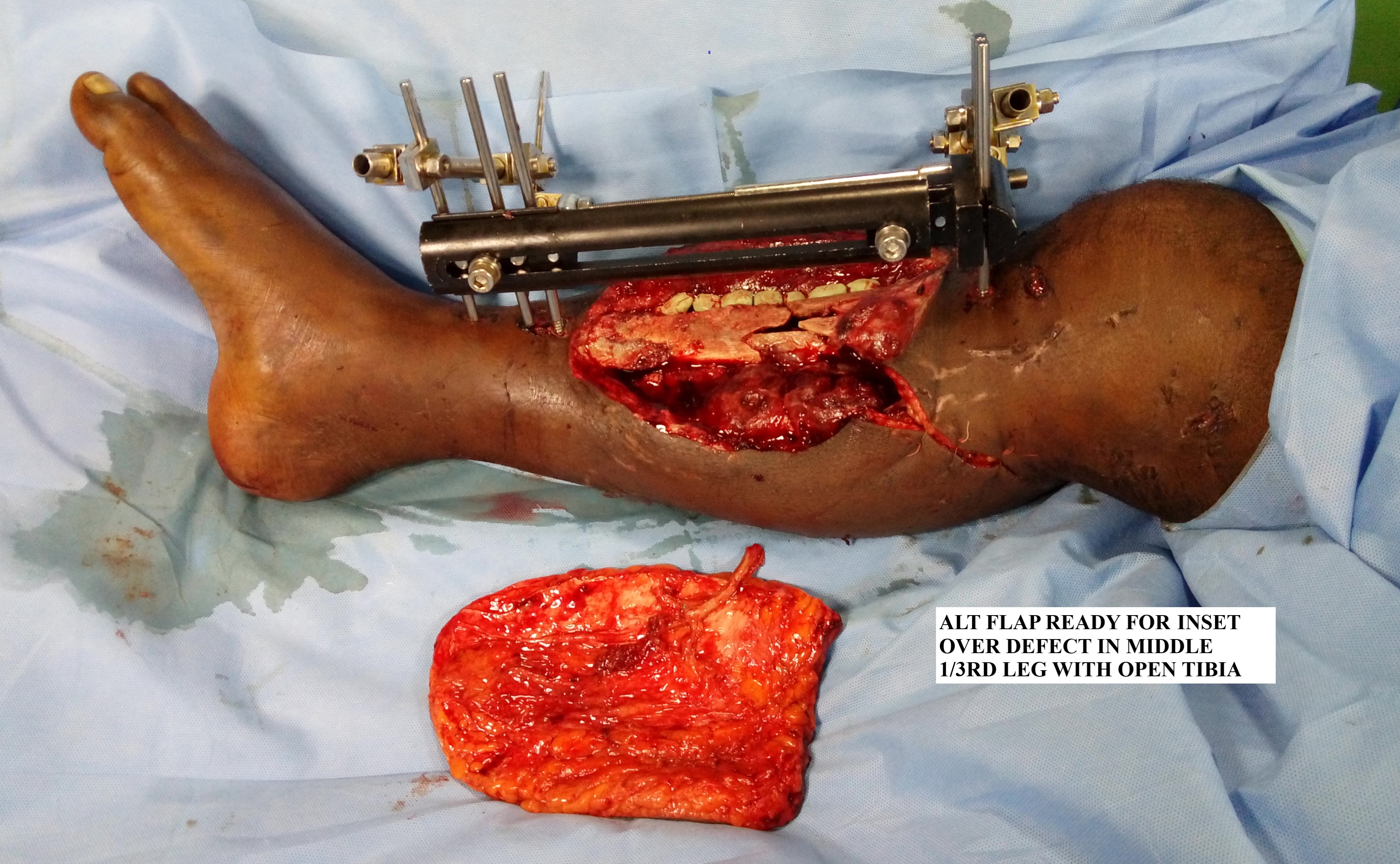 <p>Anterolateral Thigh Flap Before Inset
