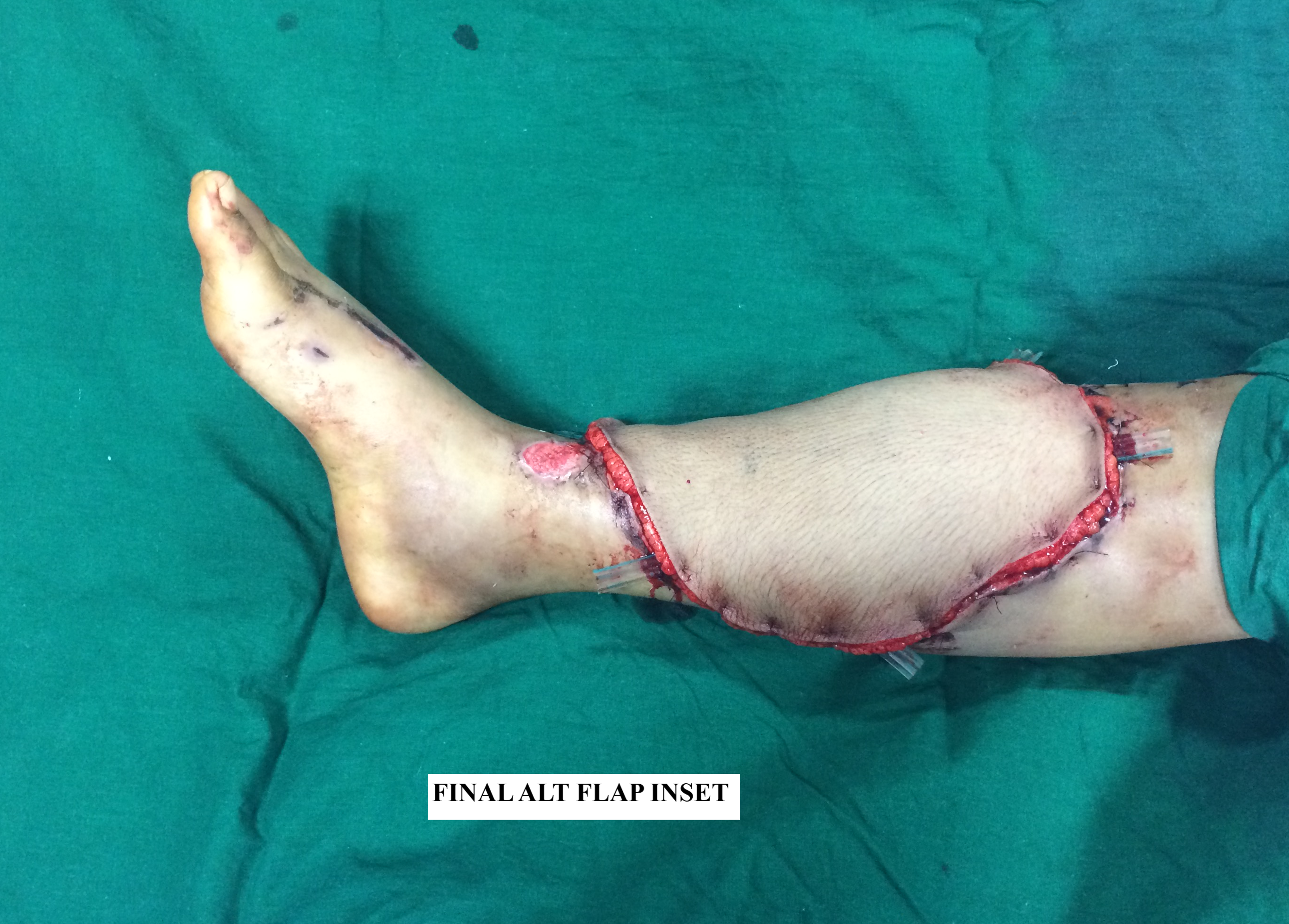 <p>Anterolateral Thigh Flap After Inset