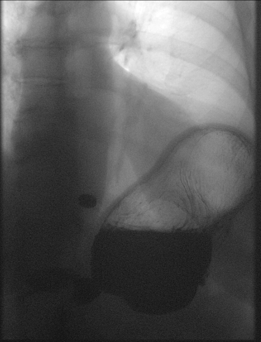 <p>Pill Retention in the Distal Esophagus