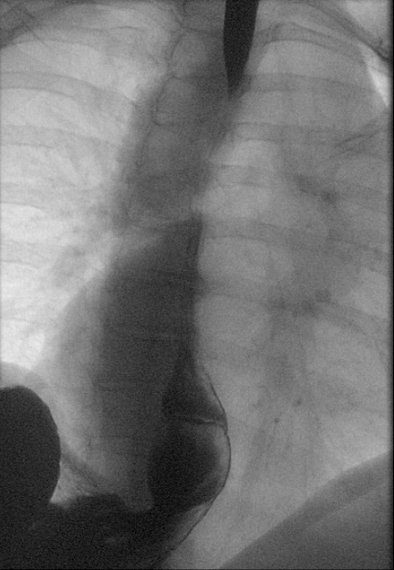 <p>Hiatal Hernia on Fluoroscopy