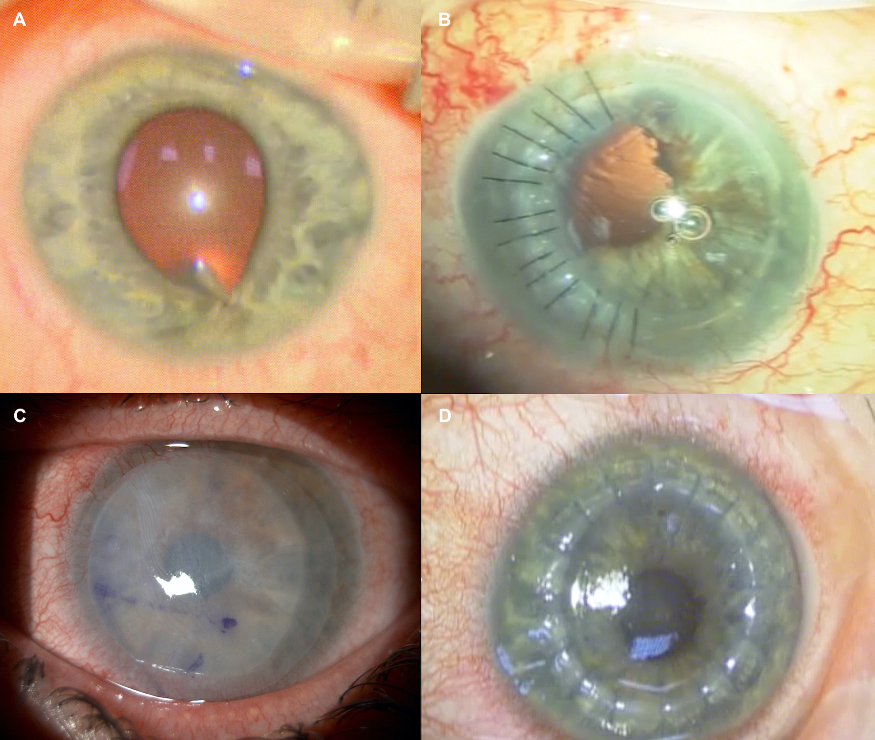 <p>Corneal Trauma: Clinical Presentations and Surgical Management