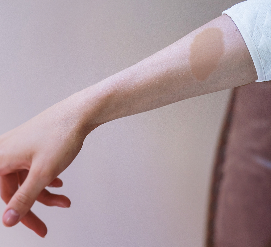 <p>&nbsp;Caf&eacute; au Lait Macule on the Forearm