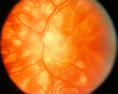 <p>Birdshot Retinopathy.</p>