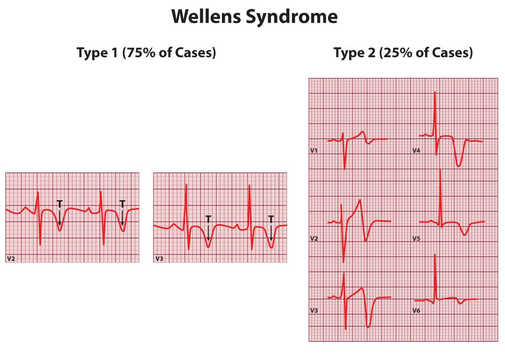 <p>Wellens Syndrome. Wellens syndrome, including type 1 and type 2.</p>
