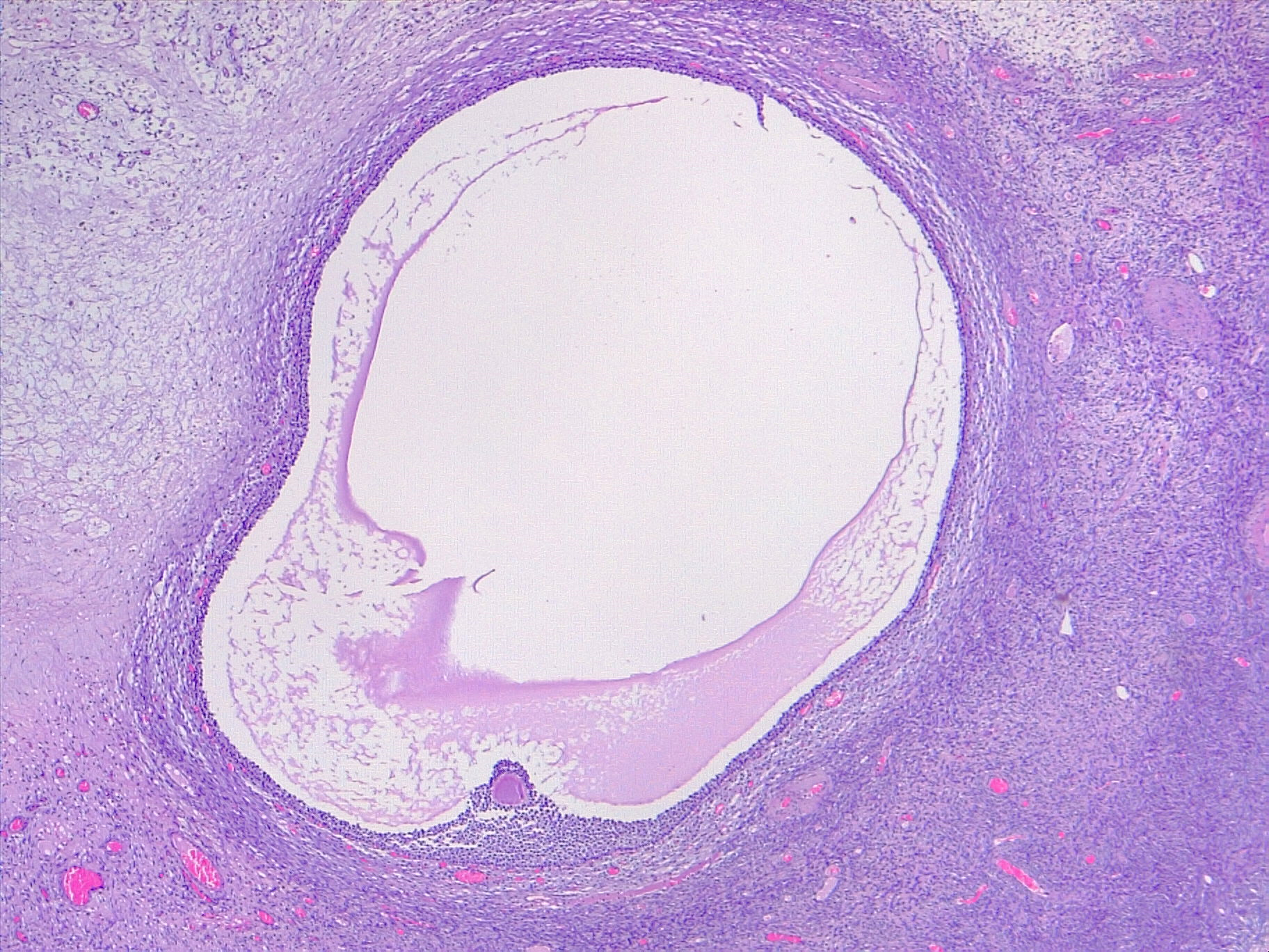 <p>Mature Ovarian Follicle