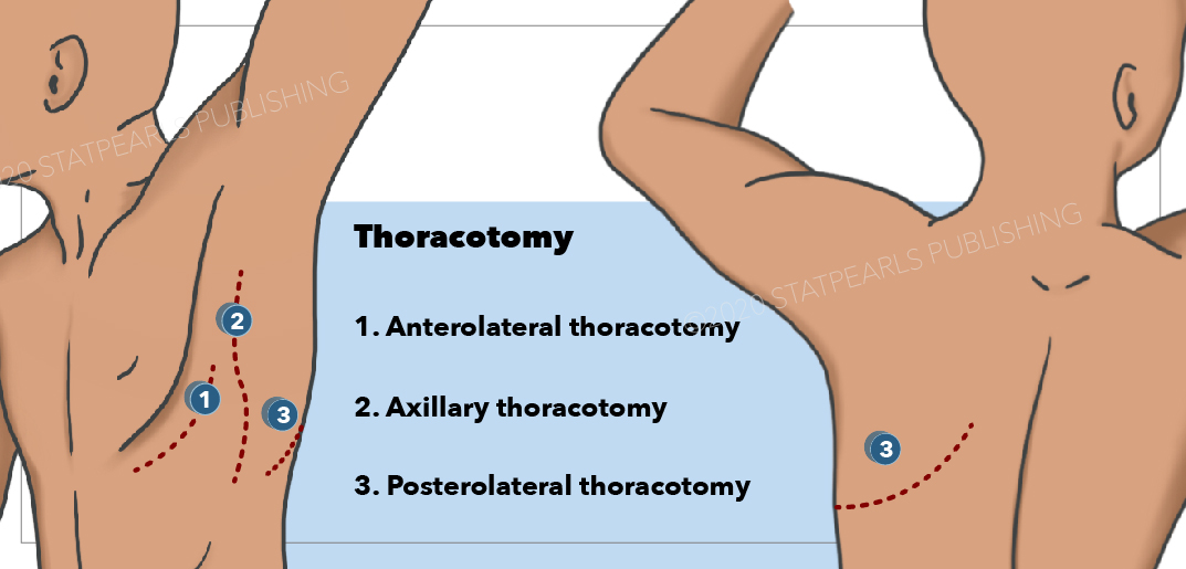 <p>Surgical Incision Pathways for Thoracotomy Procedures