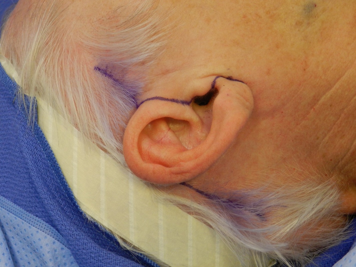 <p>Blair Rhytidectomy. Image demonstrating the posttragal approach in a female patient.</p>