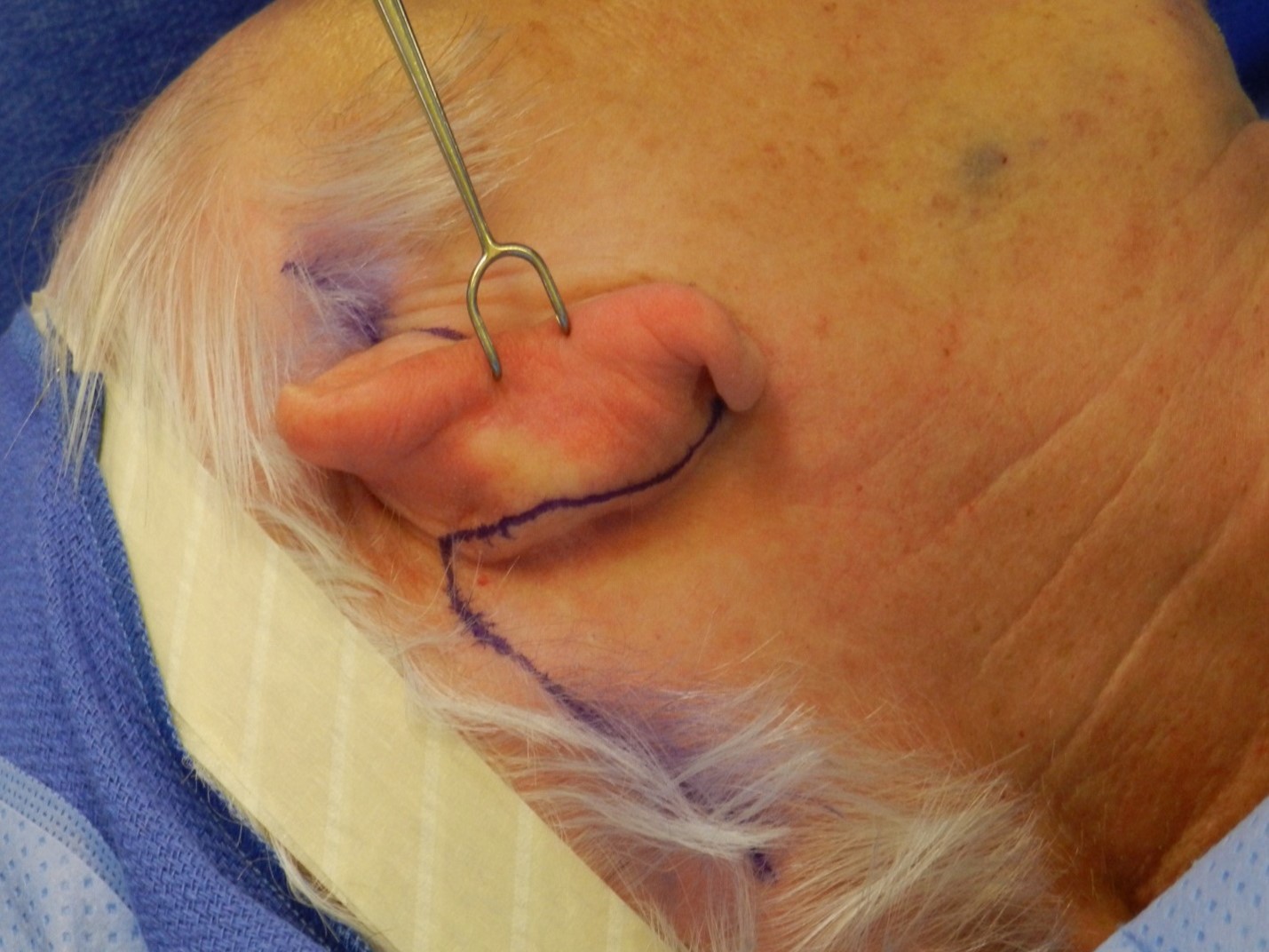 <p>Blair Rhytidectomy Incision. Image demonstrating the postauricular aspect of the incision.</p>