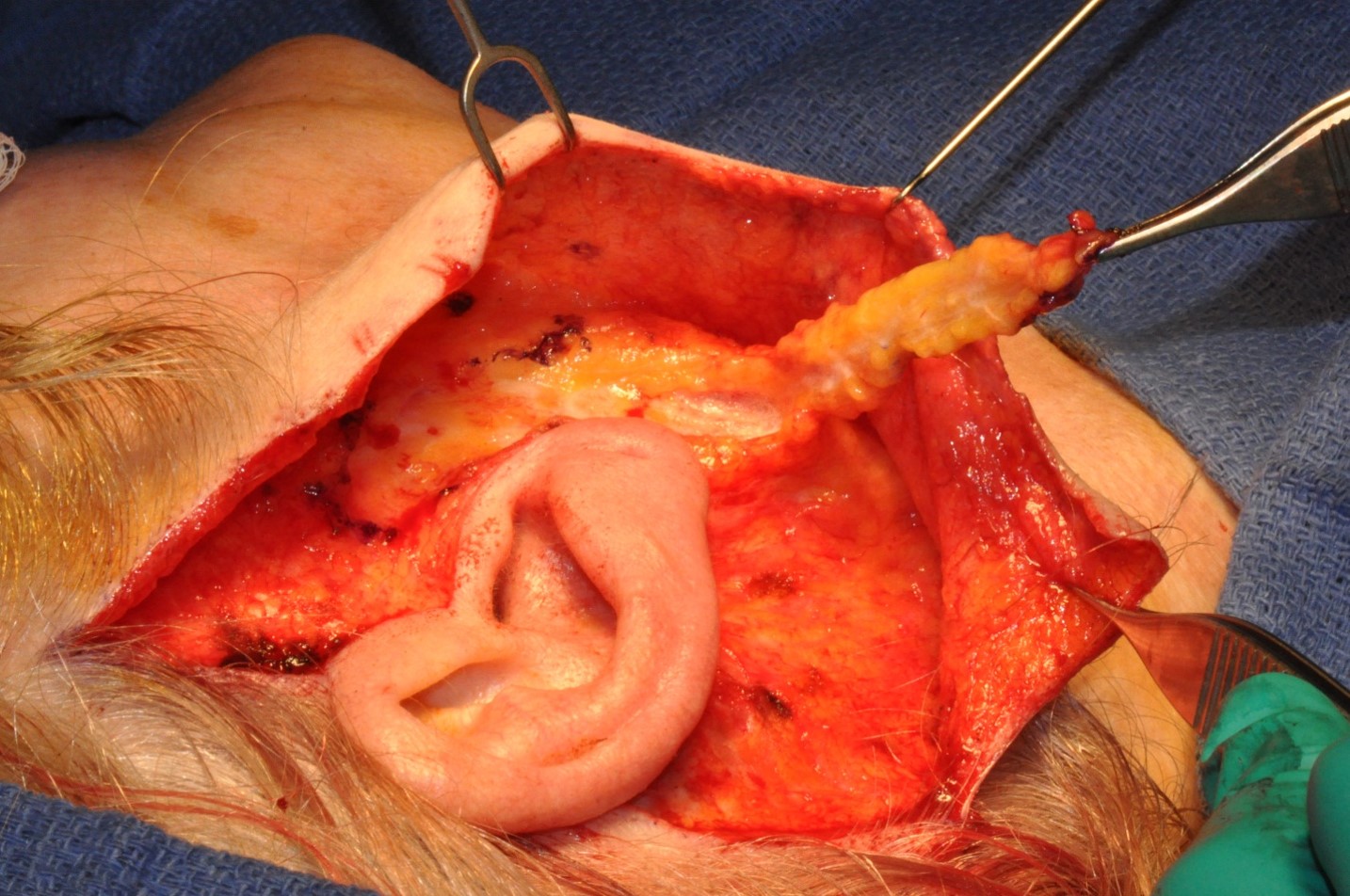 <p>Inferiorly Based SMAS Flap