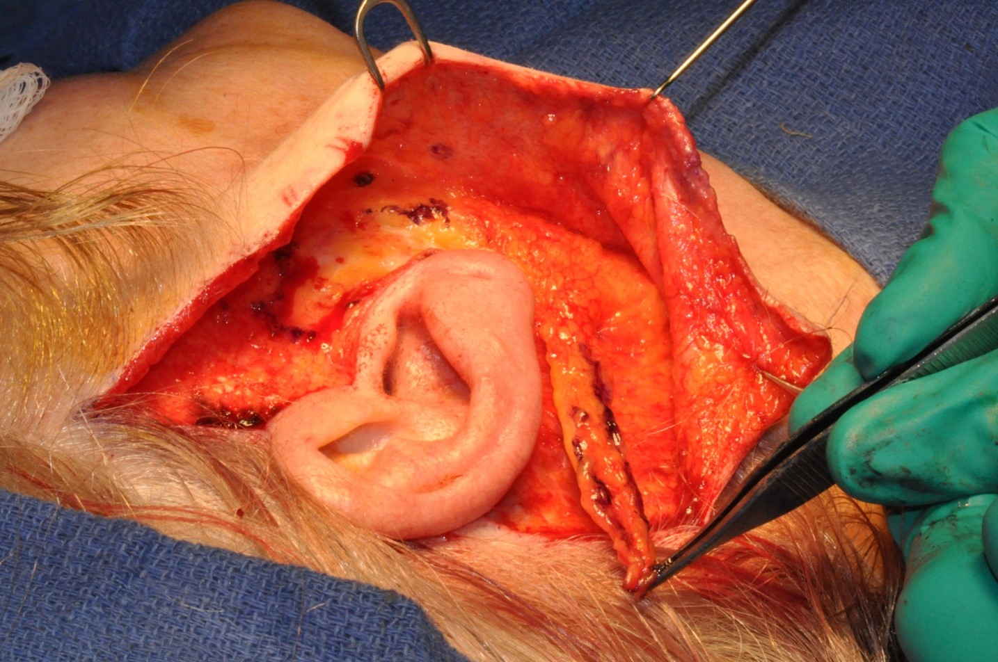 <p>SMAS Flap Transposition