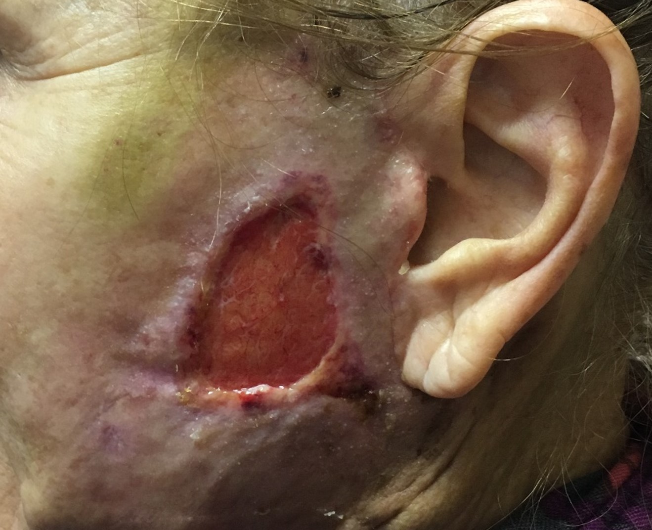 <p>Full-Thickness Skin Flap Necrosis