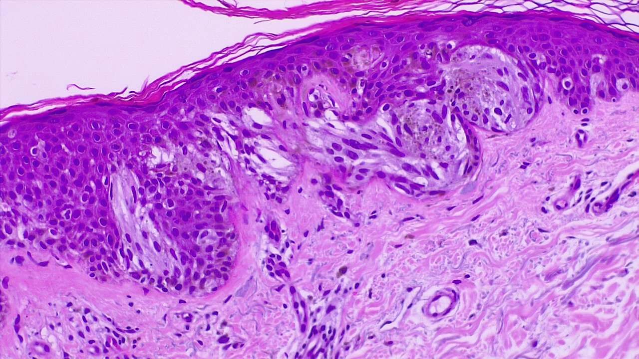 <p>Malignant Melanoma of the Skin. Epidermal invasion by atypical melanocytes, fused nests. H/E 4&times;.</p>