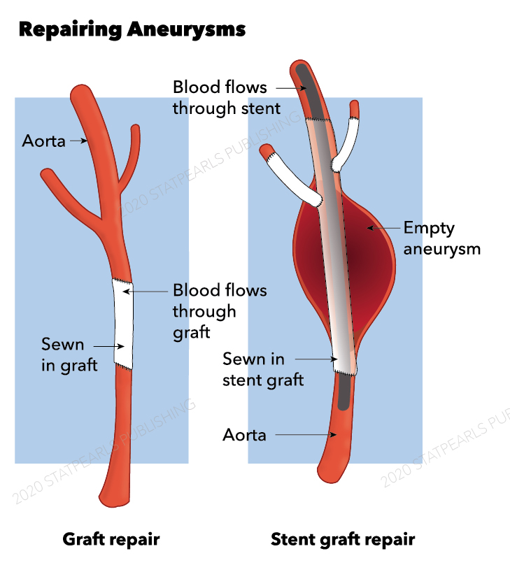 <p>Aneurysm Repair, Stent, Graft, Aorta.</p>