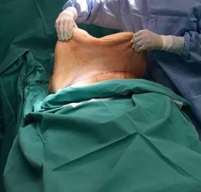 <p>Abdominal Panniculus.</p>