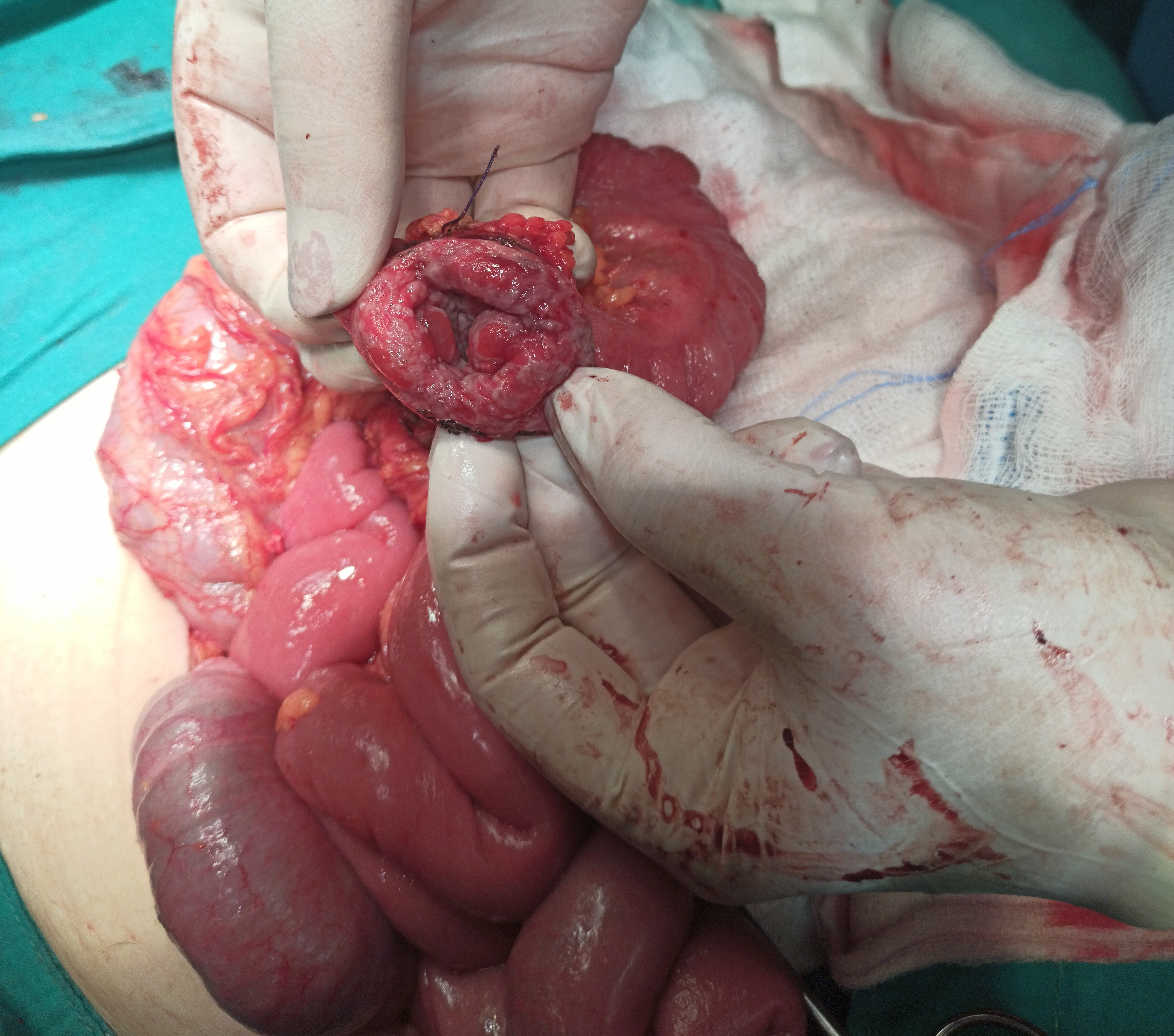 <p>Subtotal Colectomy in Severe Crohn Colitis