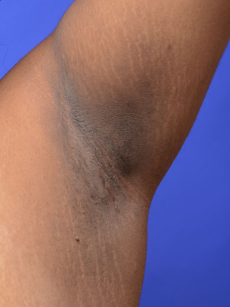 <p>Axillary Acanthosis Nigricans.</p>