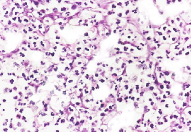 <p>Breast Abscess Inflammatory Infiltration