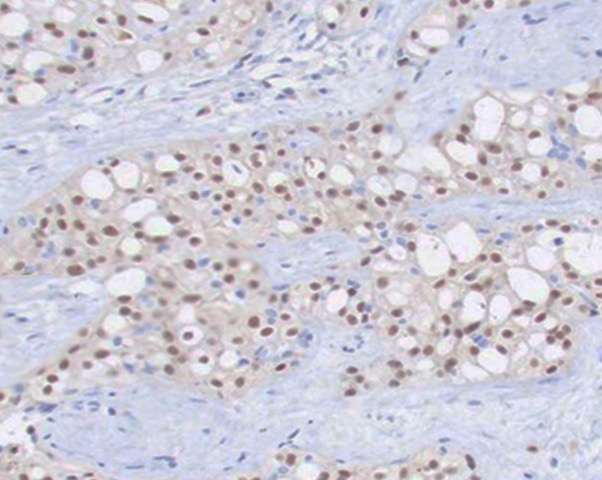 <p>Pleomorphic Lobular Breast Carcinoma</p>
<p>&nbsp;</p>