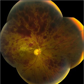 <p>Central Retinal Vein Occlusion.</p>