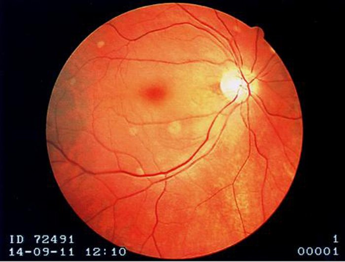 <p>Central Retinal Artery Occlusion