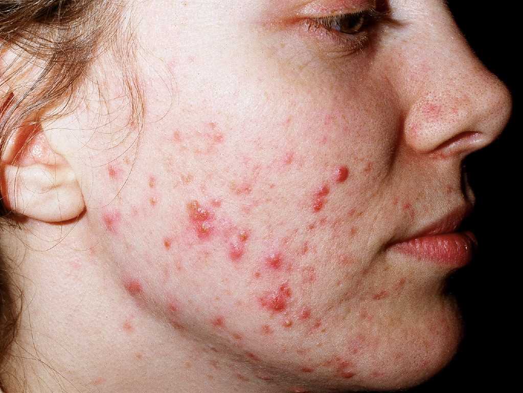 <p>Acne Vulgaris.</p>