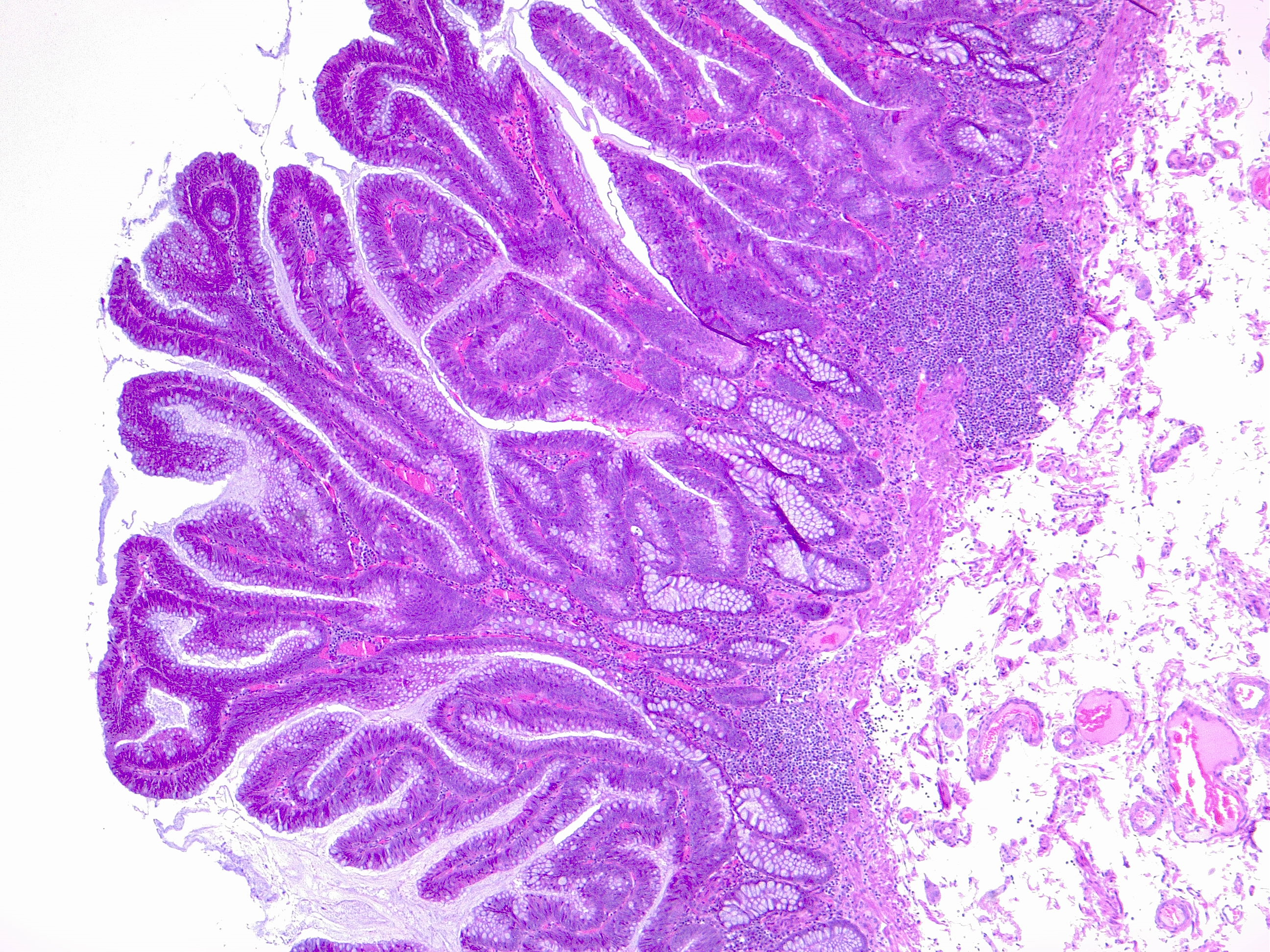 <p>Villous Adenoma