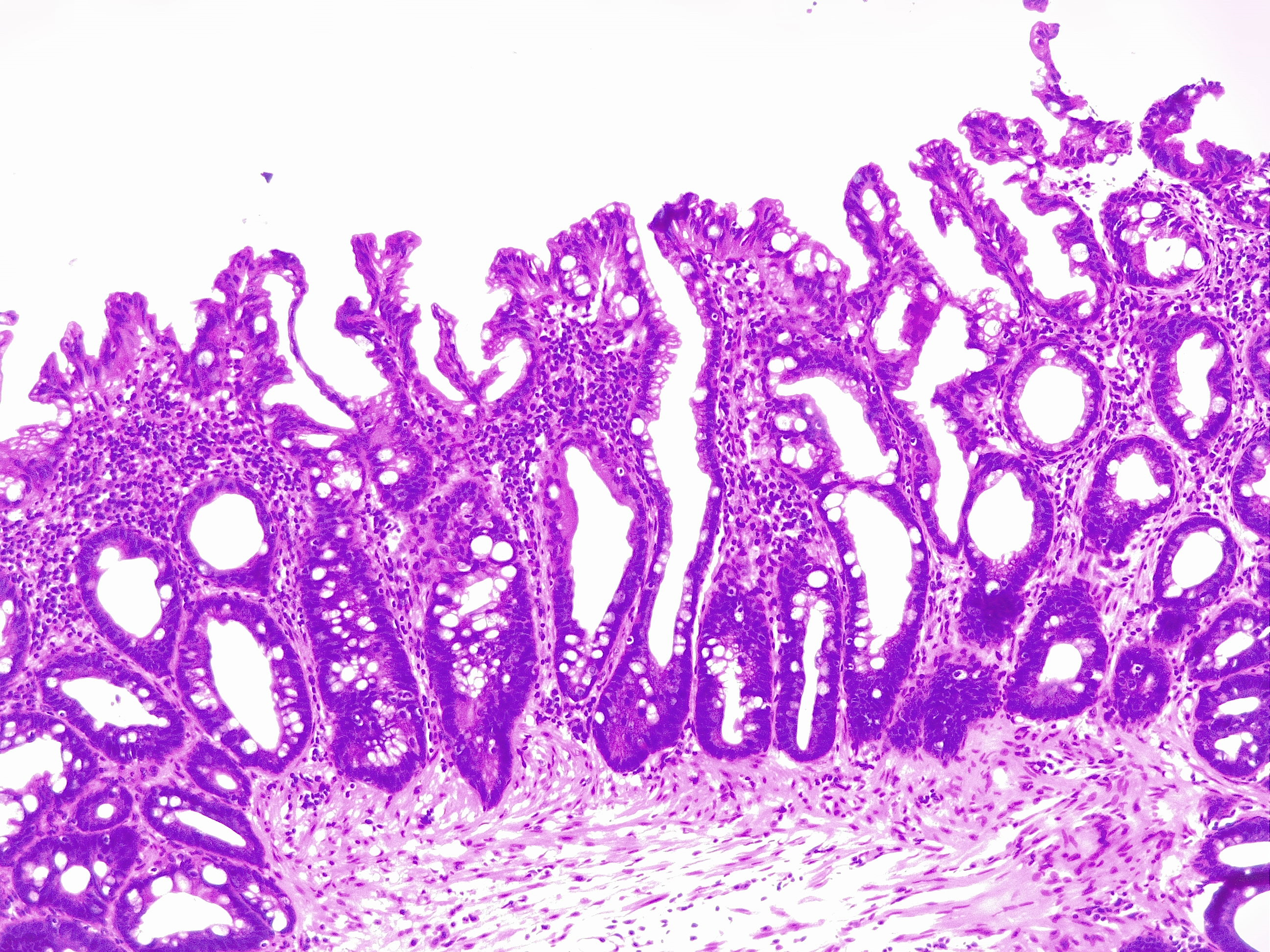 <p>Hyperplastic Polyp of the Colon