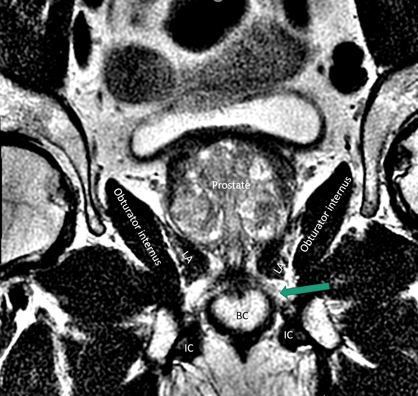 <p>Prostate and Adjacent Structures on Magnetic Resonance Imaging
