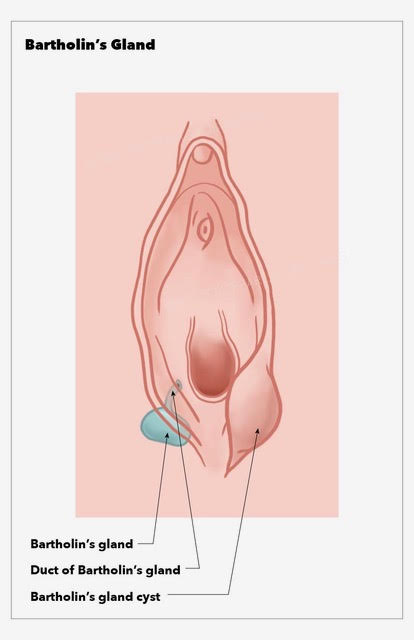 <p>Bartholin's Gland Cyst