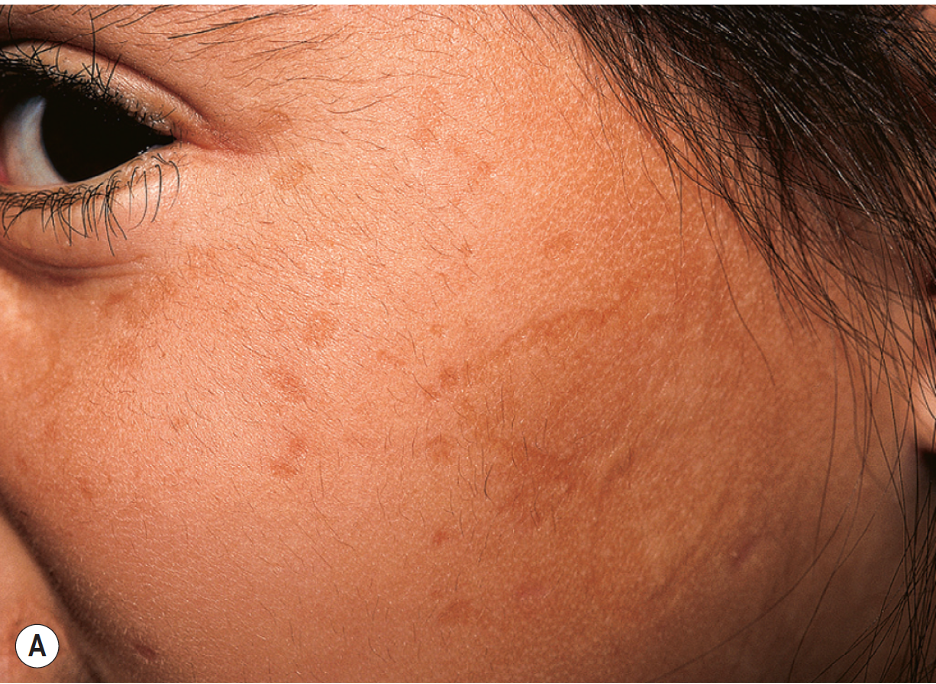 <p>Early Cutaneous Findings of Lipoid Proteinosis