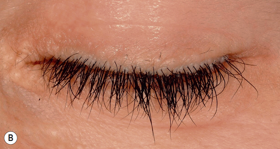 <p>Moniliform Blepharosis